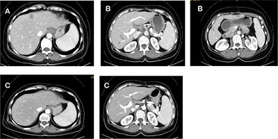 Ongoing complete response after treatment cessation with dabrafenib, trametinib, and cetuximab as third-line treatment in a patient with advanced BRAFV600E mutated, microsatellite-stable colon cancer: A case report and literature review